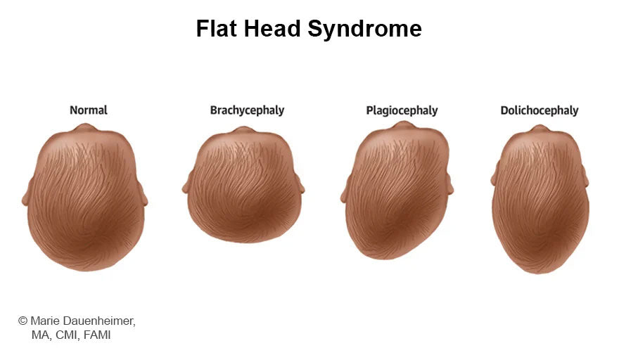 The Ultimate Guide to Flat Head Syndrome Prevention